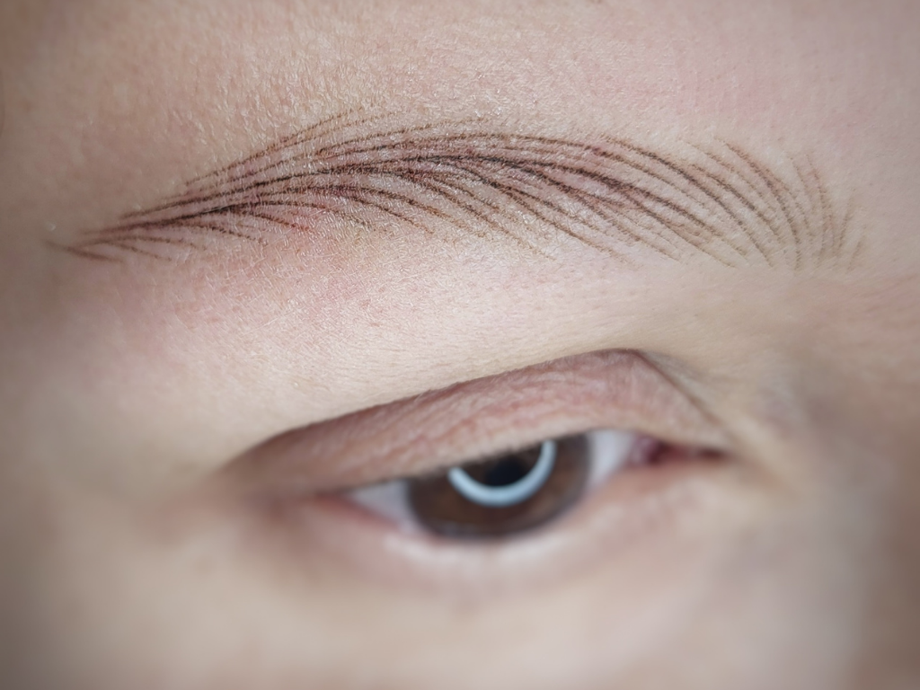 Sourcils poil à poil - Alopécie