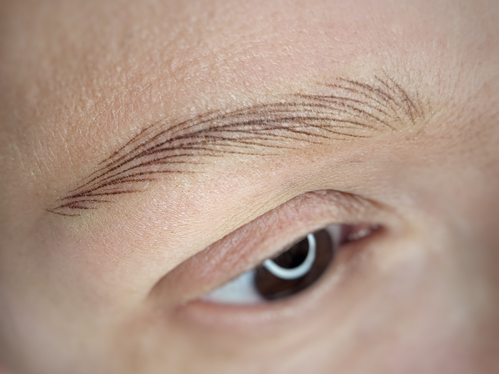 Sourcils poil à poil - Alopécie